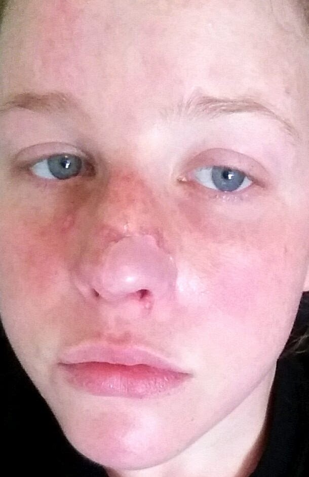 close up nose skin cancer woman