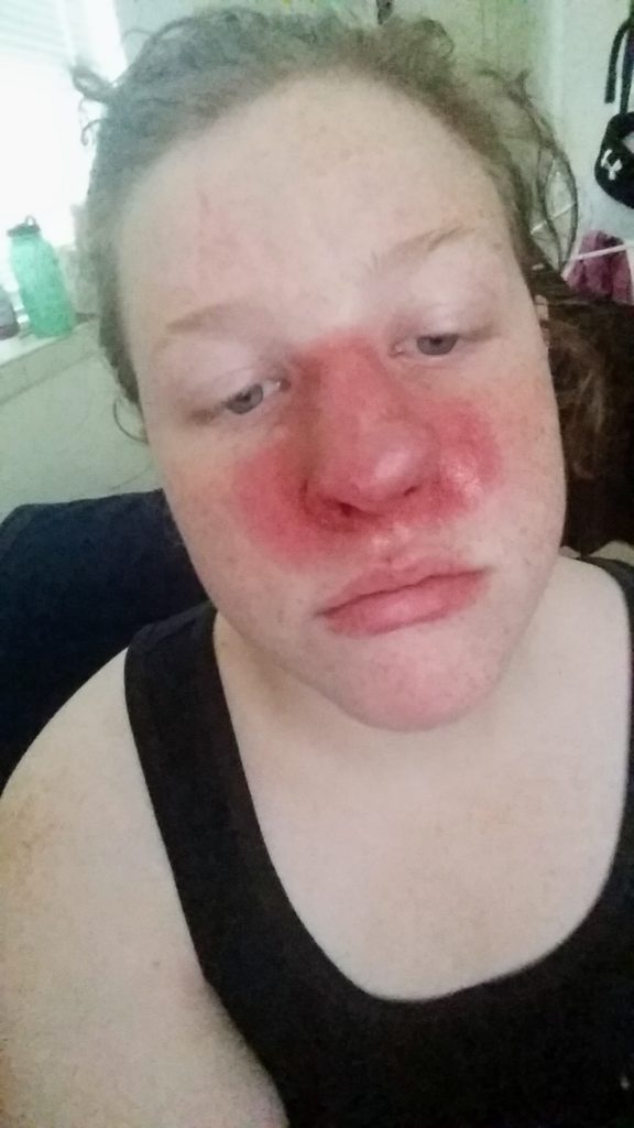 woman with skin cancer after surgery