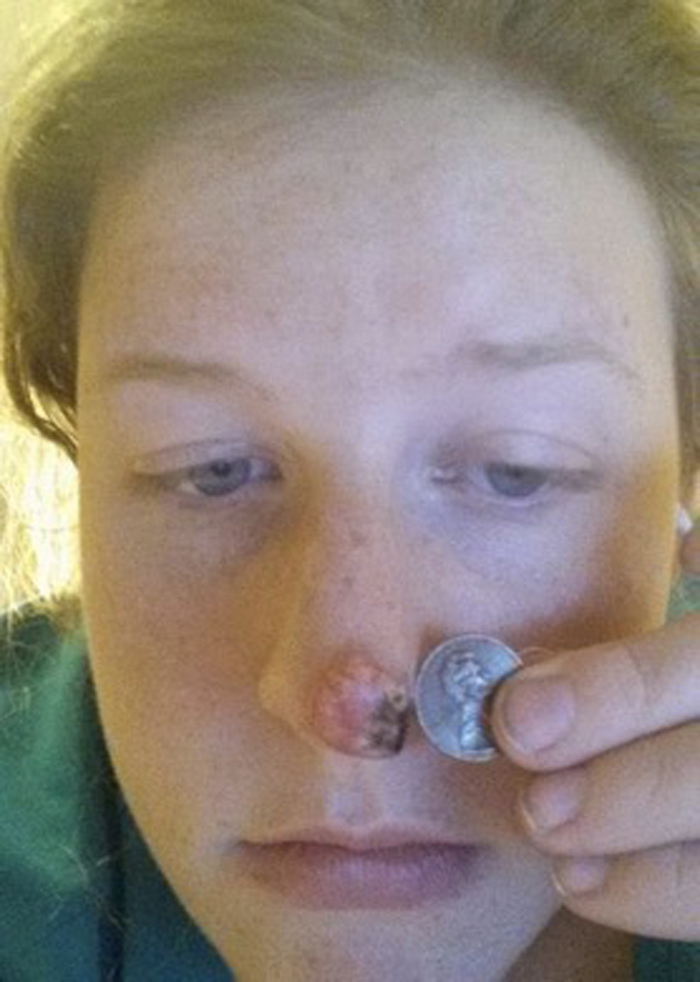 woman with skin cancer holding quarter to nose