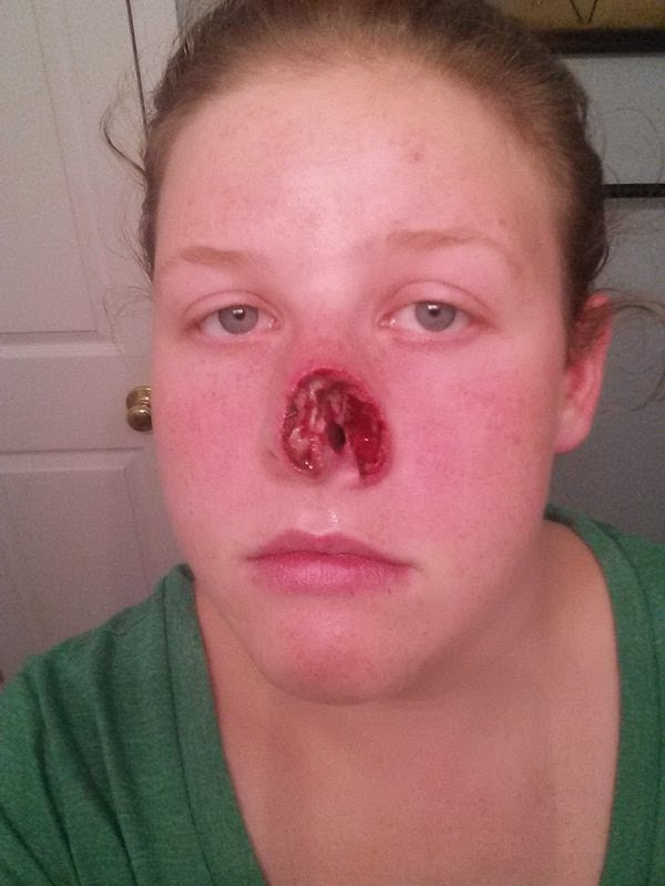 graphic photo skin cancer woman nose after surgery