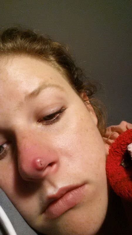 woman with skin cancer on nose