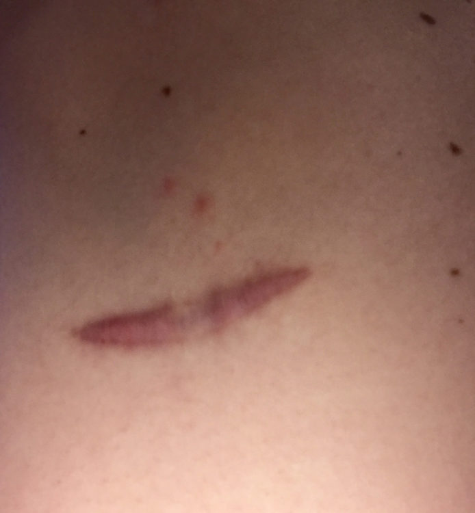 close up melanoma scar