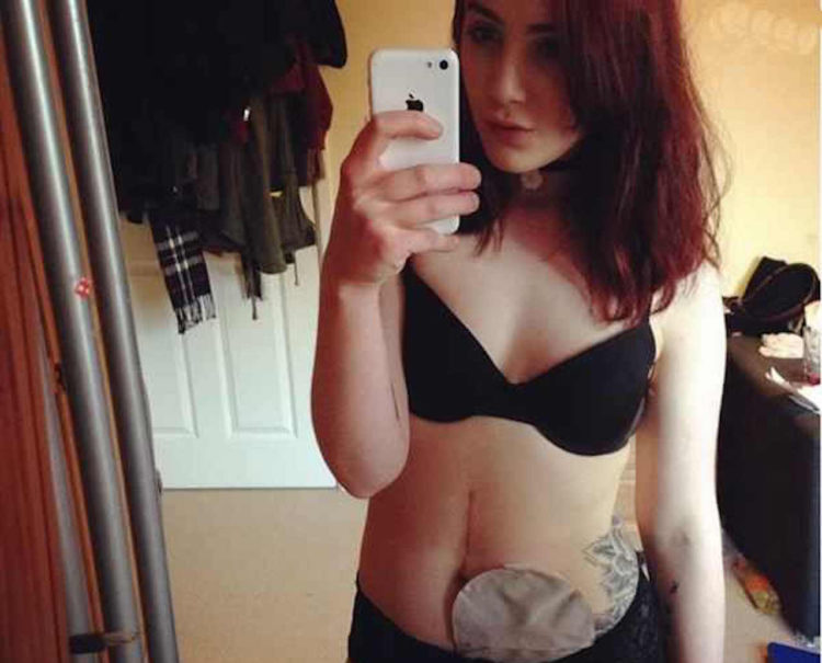 The writer standing in front of a mirror, with her ostomy.