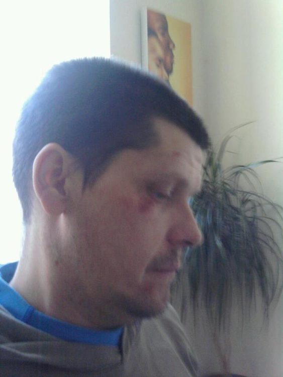 man with scratches and bruises on his face