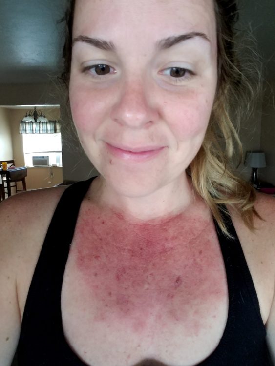 Andrea Cummings Day 14 skin rash