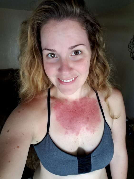 Andrea Cummings Day 21 skin rash