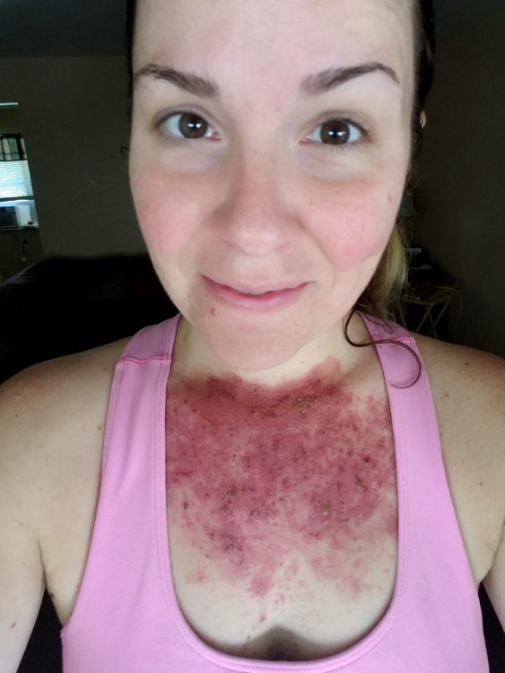 Andrea Cummings Day 24 skin rash