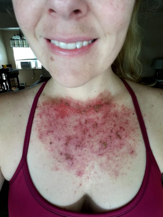 Andrea Cummings Day 28 skin rash