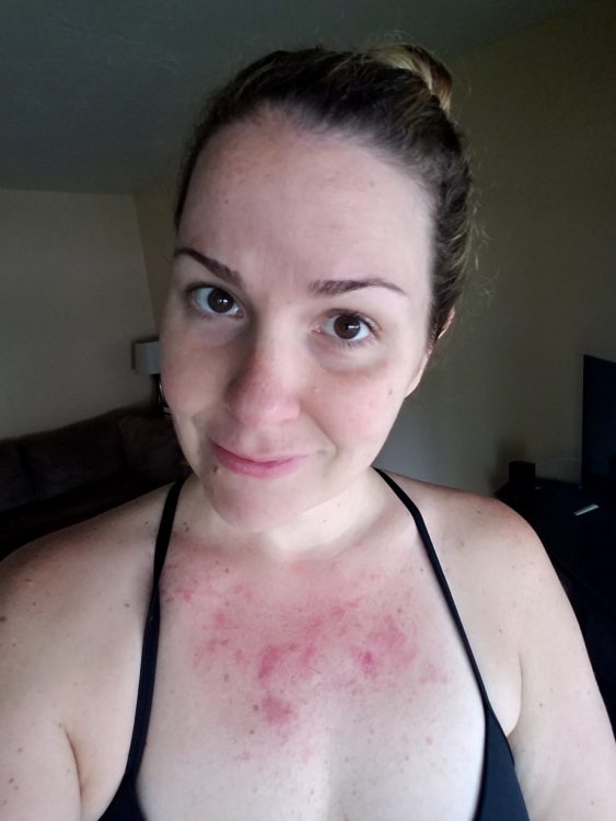 Andrea Cummings Day 8 skin rash
