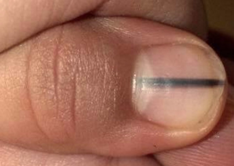 Melanoma skin cancer nail