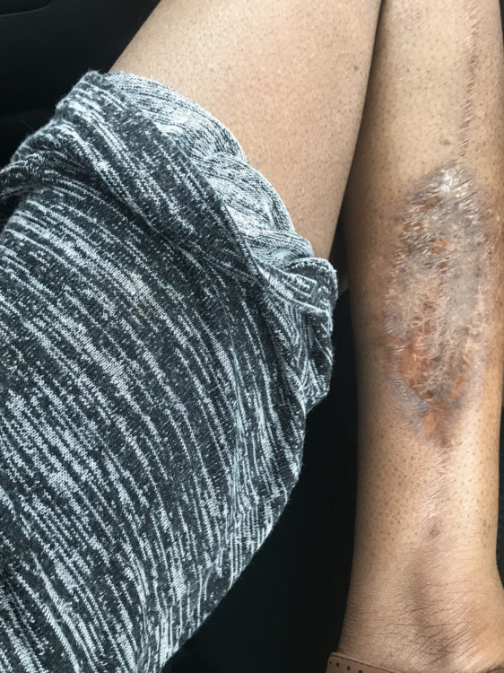 Sarah Anderson leg surgery scar