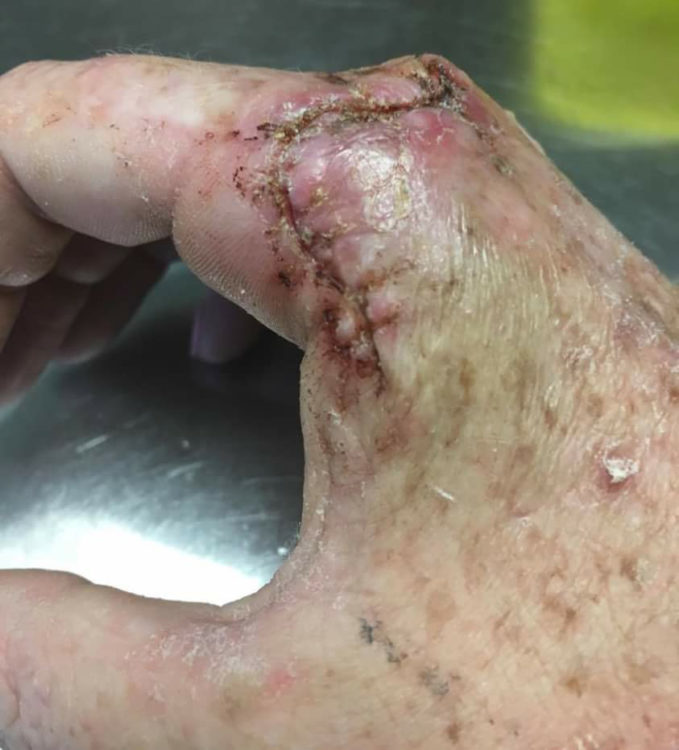 Pruzy Chamberlain skin cancer hand stitches 2