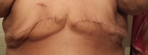 Charity Bryan 4 weeks post bilateral mastectomy
