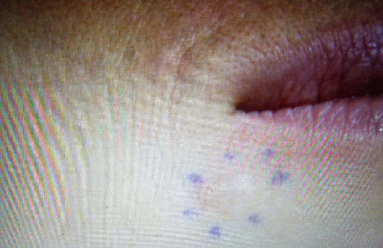 Kari Cummins skin cancer photo6