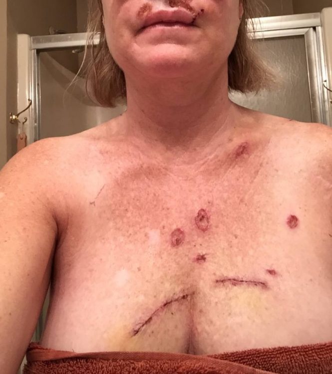 Judy Cloud 5 days post surgery chest wounds