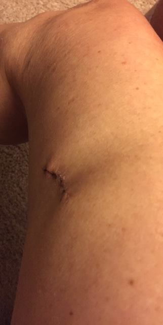 Judy Cloud incision wound on thigh 13 days post surgery