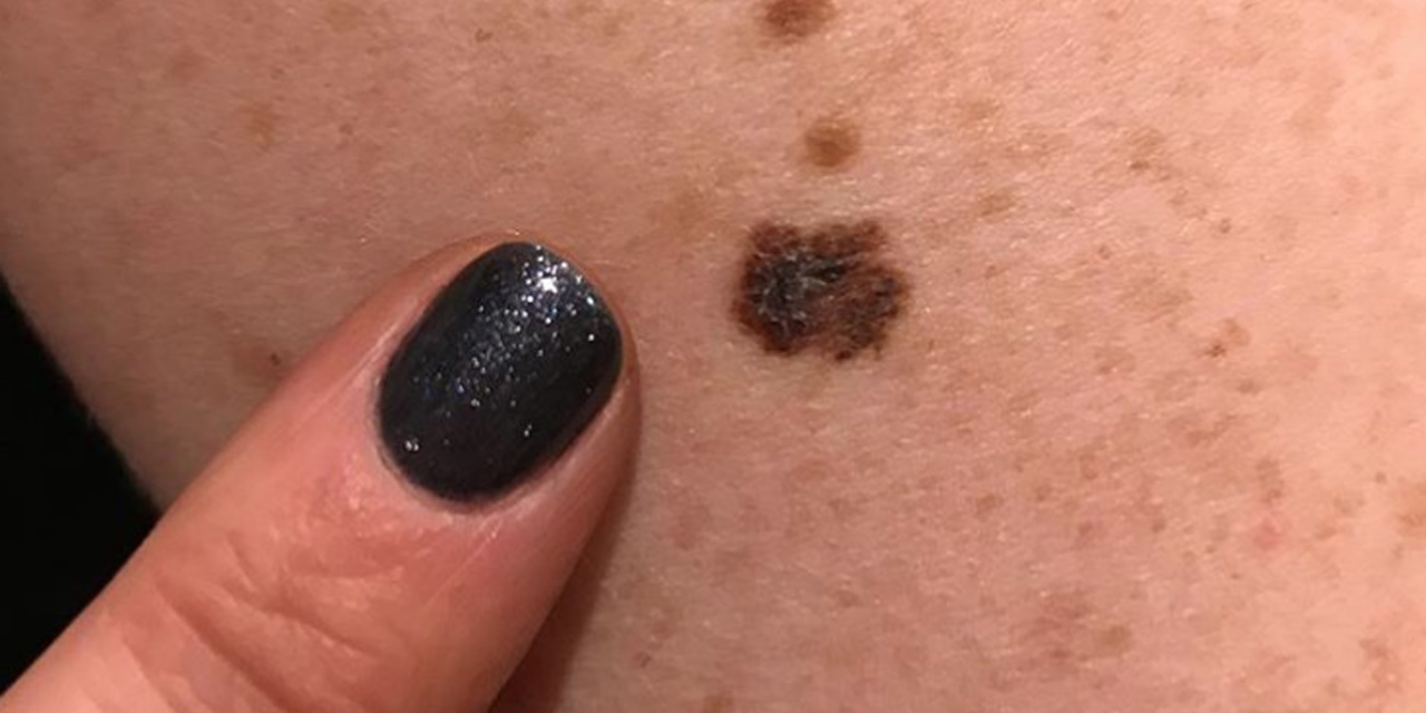 Melanoma Skin Cancer On Arm
