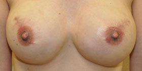 bilateral nipple tattoo after