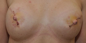 bilateral nipple tattoo before