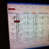 A computer screen showing seizures