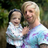 man and a child with Treacher Collins syndrome