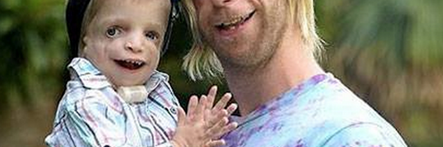 man and a child with Treacher Collins syndrome