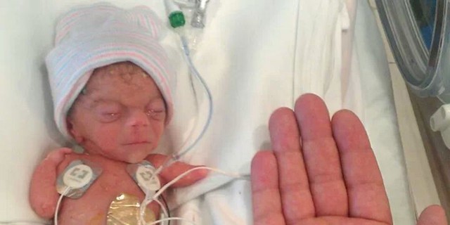 What I Wish I'd Known When My Baby Was Born the Size of My Hand