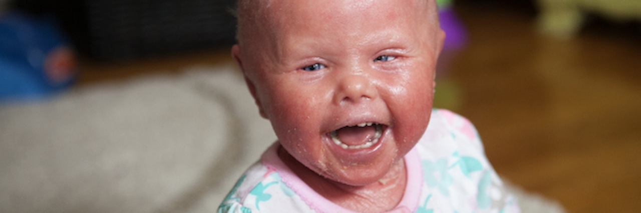 What My Daughter's Ichthyosis Doesn't Have Control Over