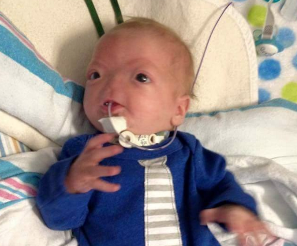 This Baby Was Born Without a Nose. His Parents Say He’s Perfect. | The ...