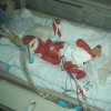 photo of premature baby