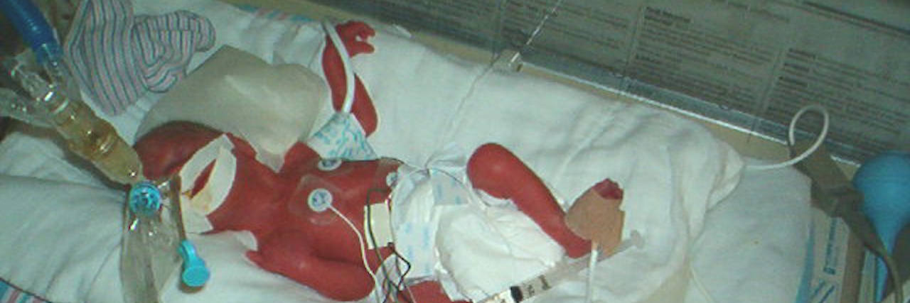 When Your Child Blames You For Their Medical Problems photo of premature baby