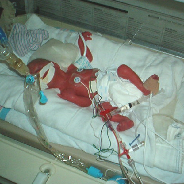 photo of premature baby