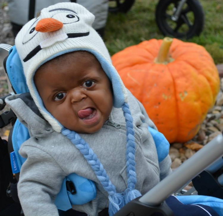 child with apert syndrome wearing an olaf hat
