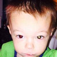 boy diagnosed with retinoblastoma after mom saw white glare over his pupil in photo