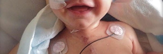 A small baby boy, smiles for camera with wires attached to his nose and his chest.