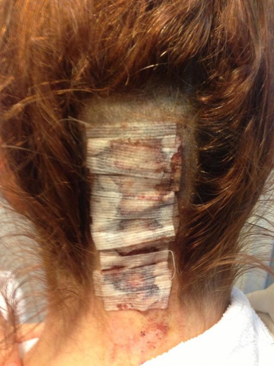 A close-up of the back of Kerri's head, partially shaved and covered with medical gauze
