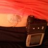 The contributor's insulin pump strapped to the top of her pants