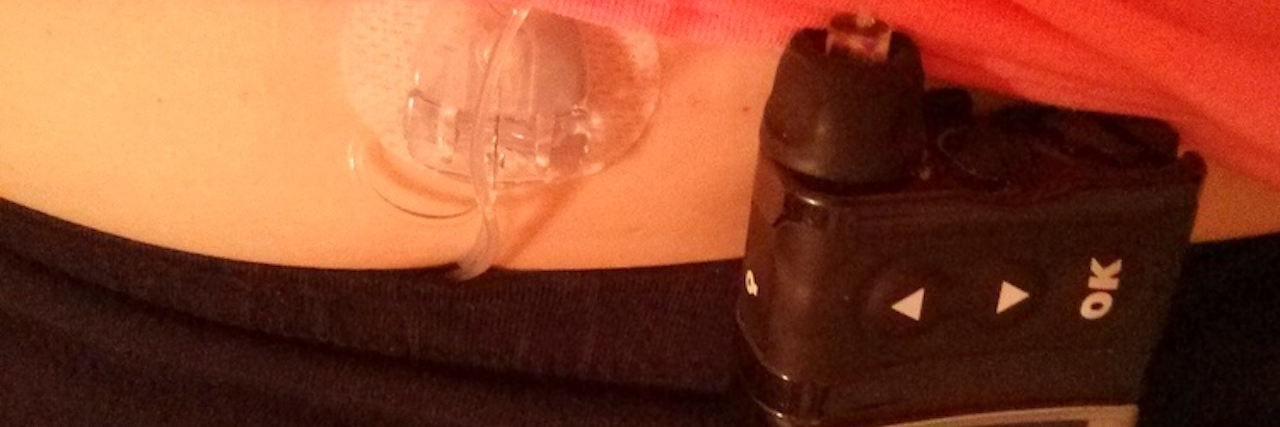 The contributor's insulin pump strapped to the top of her pants