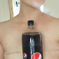 woman holding coke against chest with mastectomy scars showing