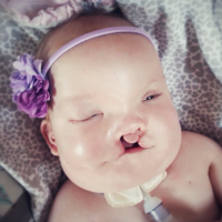 Baby girl with cleft lip