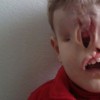Yahya El Jabaly, boy born without eyes or upper jaw, before surgery