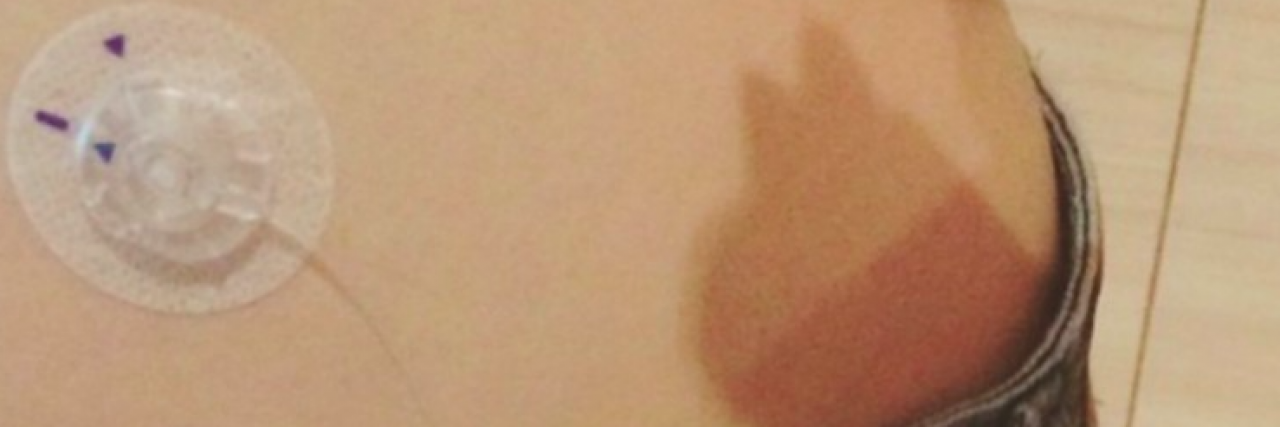 Why I No Longer Hide the Equipment I Need to Manage My Diabetes