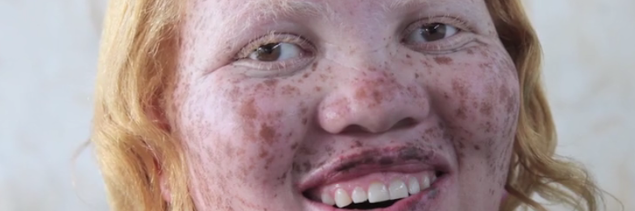 Rick Guidotti Photographs People With Visible Health Conditions Rick Guidotti's photograph of Jayne Waithera, a young woman with albinism