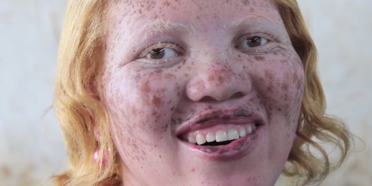 Portrait Series Highlights Beauty of Albinism, Birthmarks & Other Skin  Conditions