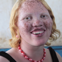 Rick Guidotti's photograph of Jayne Waithera, a young woman with albinism