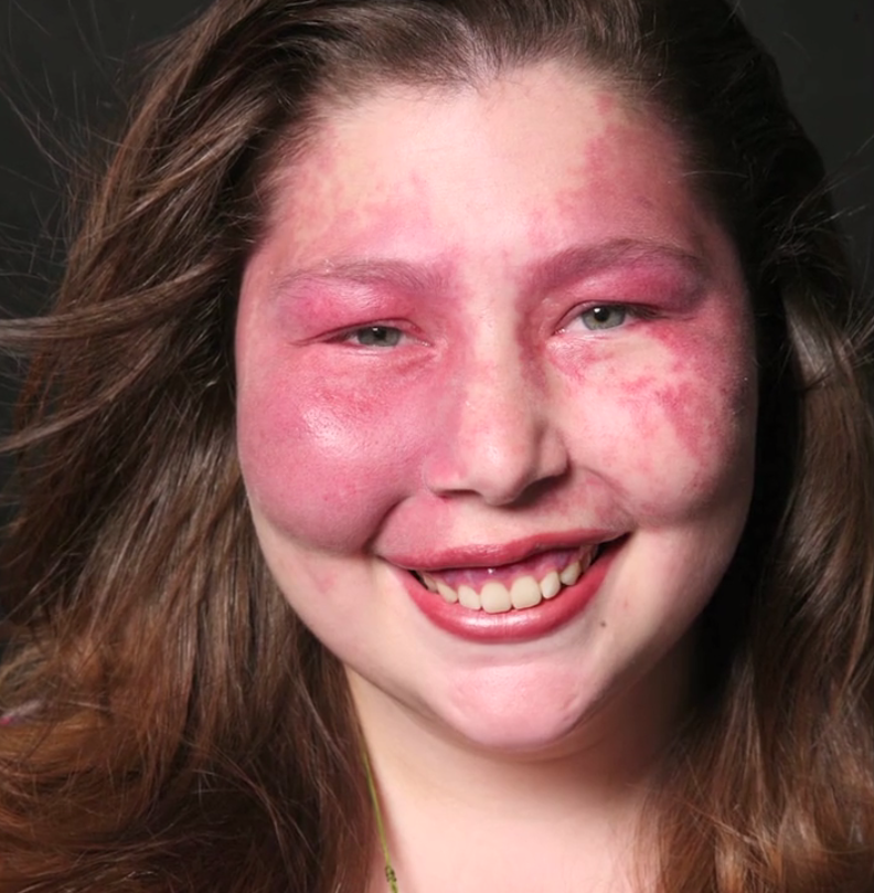 photograph of Sarah Kanney, young woman with Sturge-Weber Syndrome