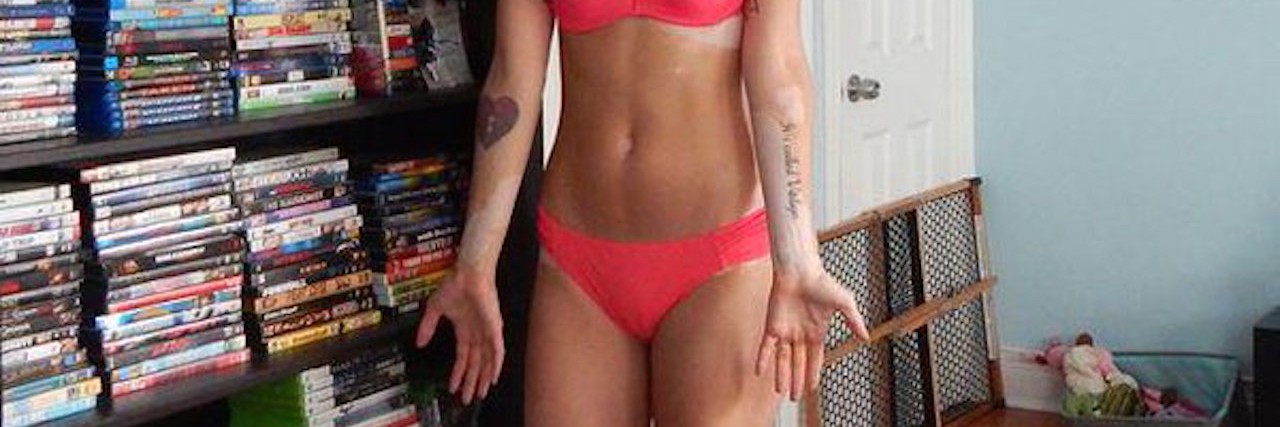 Woman with vitiligo in bikini. There are white splotches on her arms and chest.