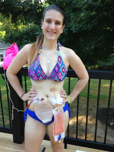 author in bikini showing off her ileostomy, a G-tube and a J-tube,