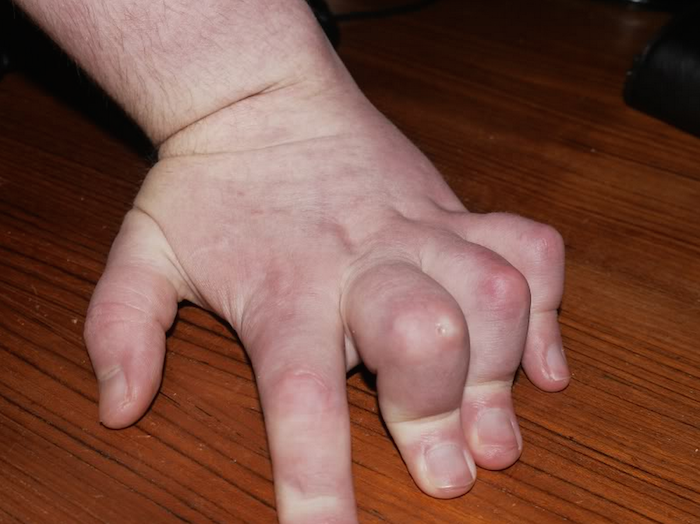 man's hand swollen and bent due to arthritis