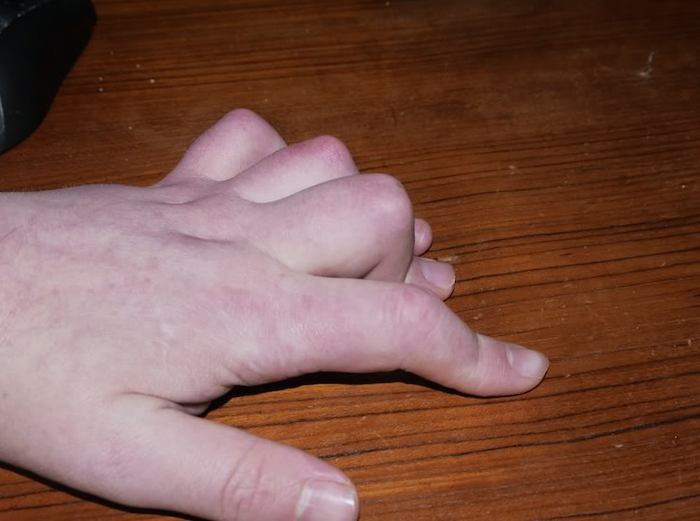 man's fingers bent due to arthritis